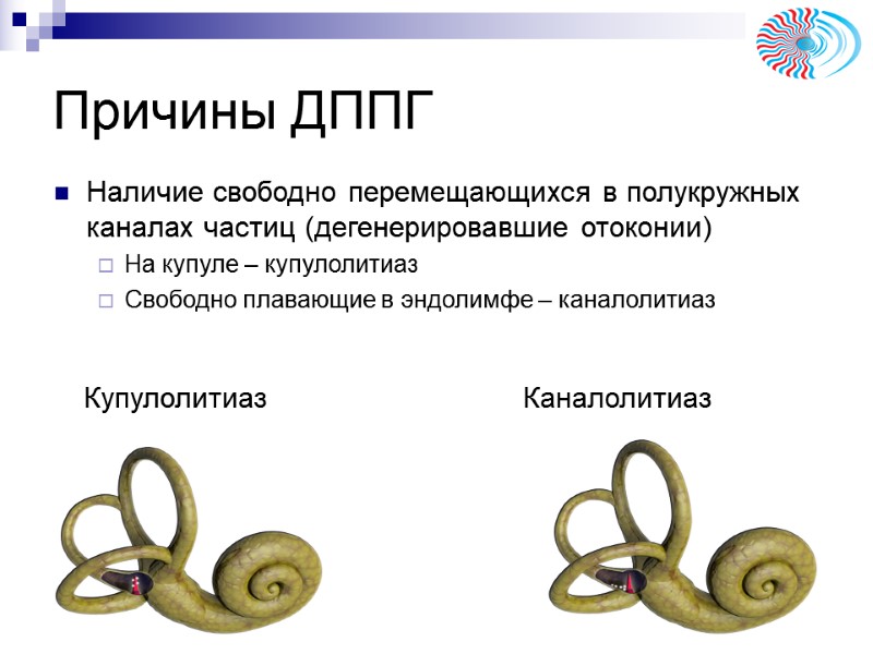 Причины ДППГ Купулолитиаз Каналолитиаз Наличие свободно перемещающихся в полукружных каналах частиц (дегенерировавшие Причины ДППГ Купулолитиаз Каналолитиаз Наличие свободно перемещающихся в полукружных каналах частиц (дегенерировавшие